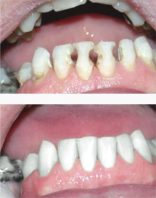 Crowns before and after